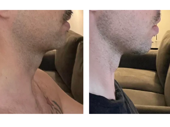 Before and after mewing adult man jaw transformation
